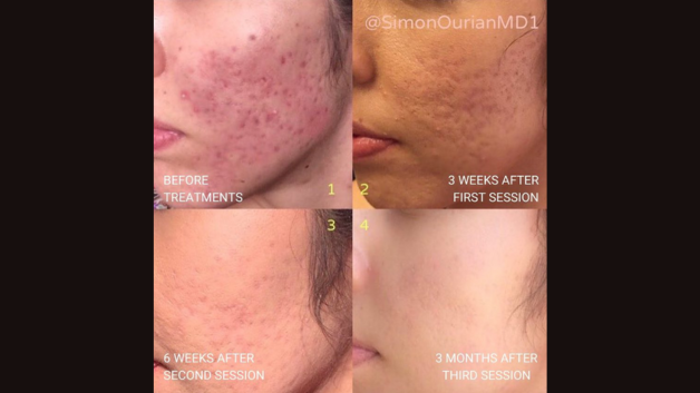 Flawless Skin Awaits: Discover Dr. Simon Ourian’s Latest Breakthrough in Acne Scar Removal