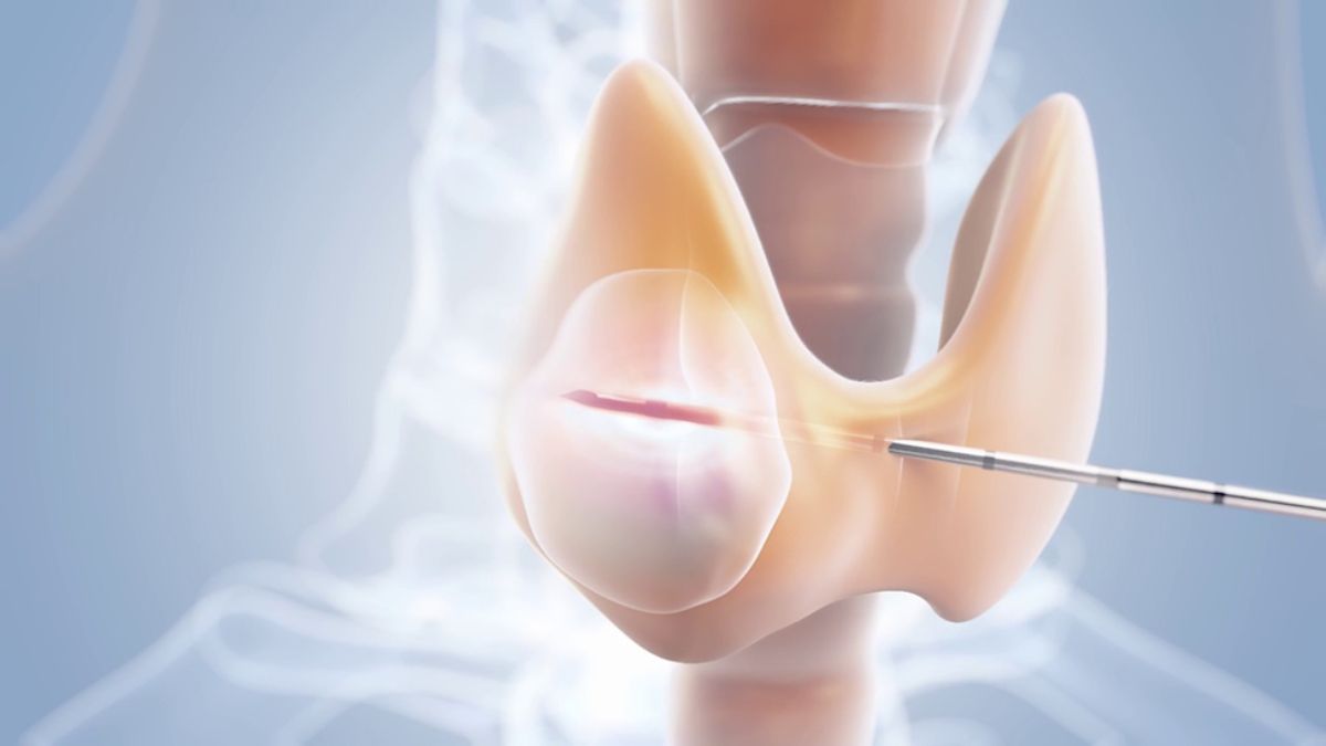 Treatment of thyroid nodules in India, the blunt times