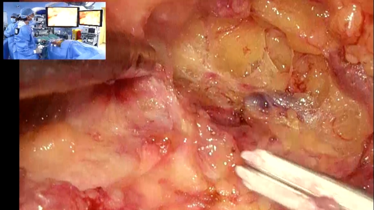 The Top Urologist in Kolkata, Dr. Tarun Jindal Performs Live VEIL Surgery at UroOncoCon 2026-TBT