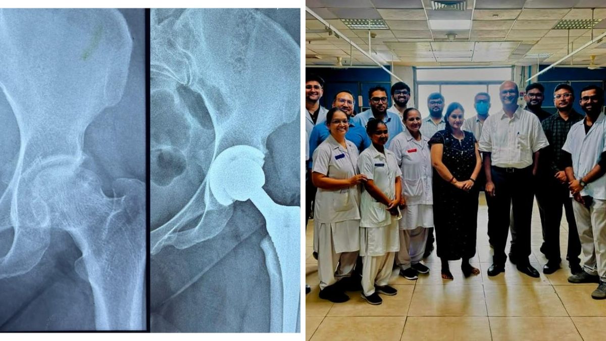 Ahmedabad Civil Hospital hip replacement, the blunt times