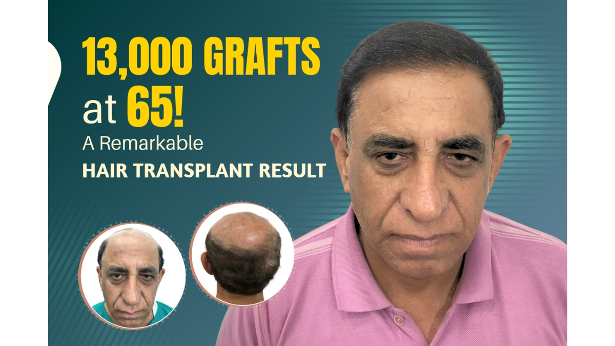 Hair Transplant